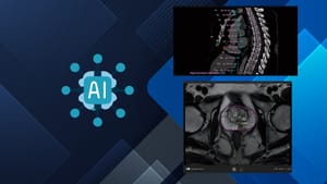 IA de Siemens Healthineers destaca en Intel Vision 2025: Mejoras en el tratamiento contra el cáncer
